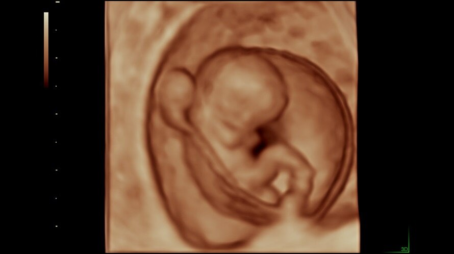 voluson-performance-p8_clinical_images_3d-rendered-9-week-fetus.jpg