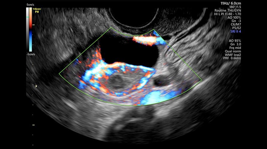 voluson-performance-p8_clinical_images_ovary-with-hdflow.jpg